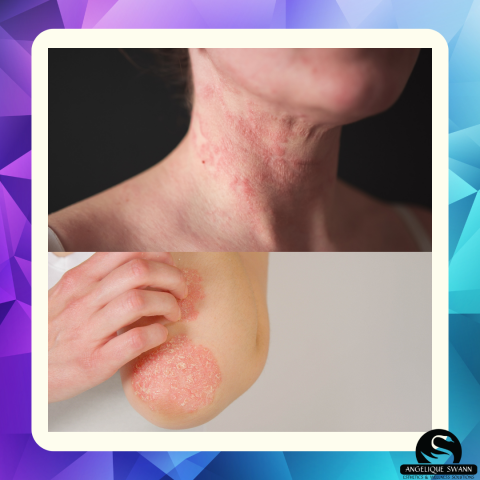 Eczema vs. Psoriasis: Understanding the Differences & Supporting Your